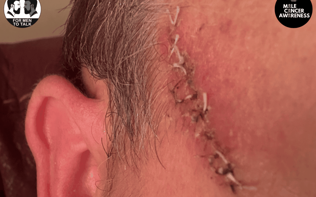 I had Skin Cancer. Please look out for the signs